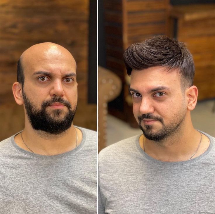 Hair Topper Result