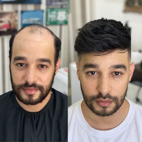 Hair Patch Transformation
