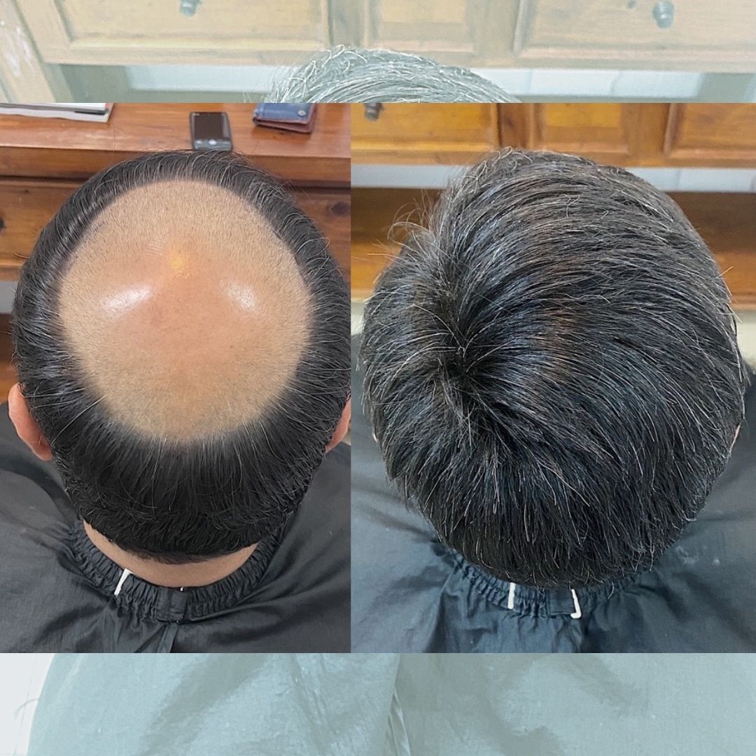 Hair Patch Transformation