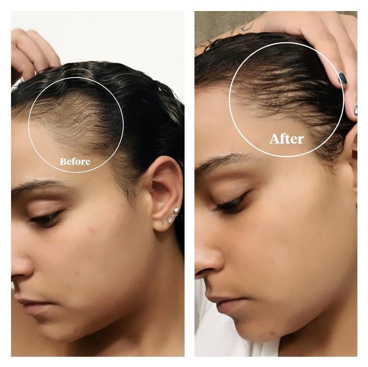 Women's Hair Patch Transformation