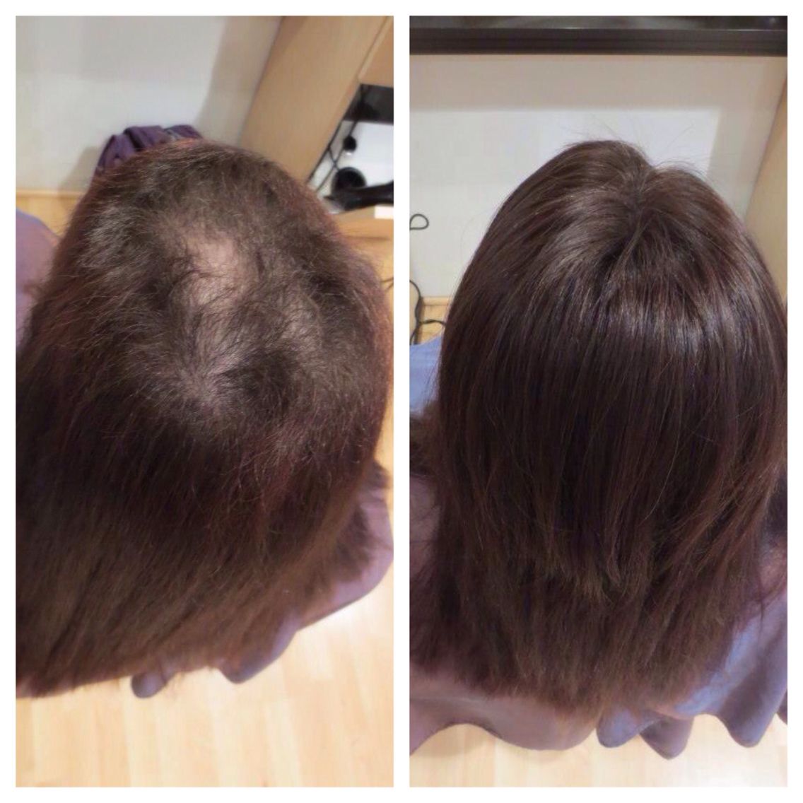Women's Hair Patch Transformation