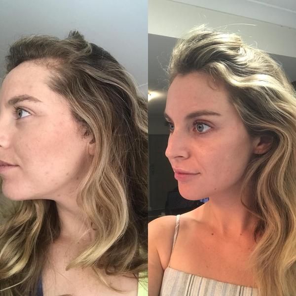 Women's Hair Patch Transformation