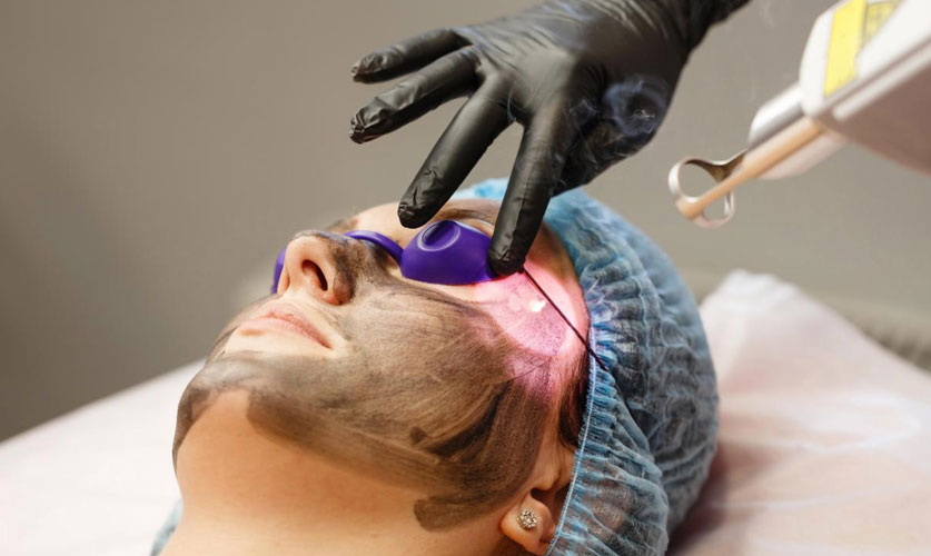 Carbon Facial | Deep Skin Rejuvenation & Glow