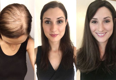 Hair Replacement Solutions