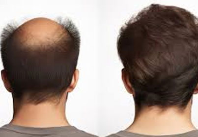 Hair Replacement Solutions